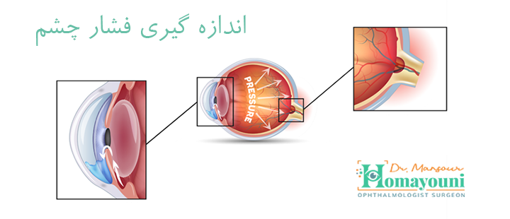 اندازه گیری فشار چشم