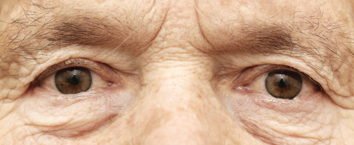 درمان پیر چشمی 