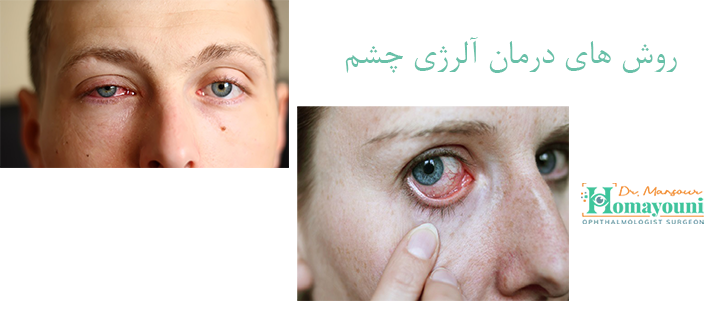 روش های درمان آلرژی چشم