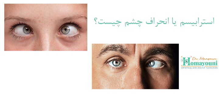 استرابیسم یا انحراف چشم چیست؟