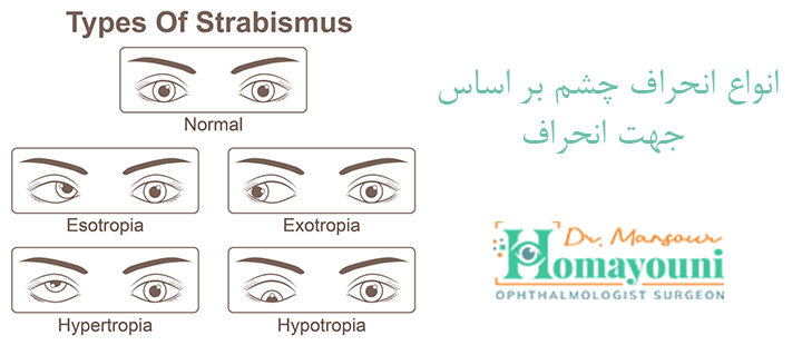 انواع انحراف چشم بر اساس جهت انحراف