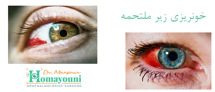 خونریزی زیر ملتحمه چیست؟