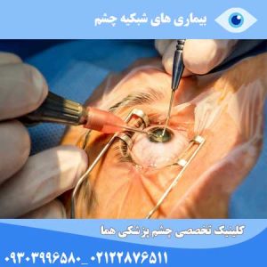 بیماری های شبکیه چشم