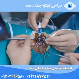 جراحی شبکیه چشم Retina