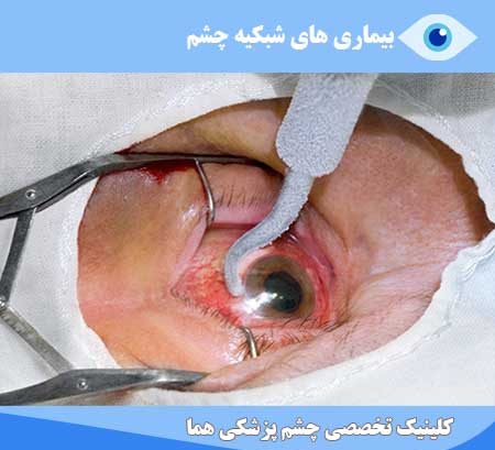 retina surgery