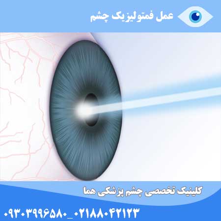 عمل فمتولیزیک چشم