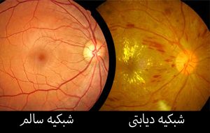 لیزر چشم دیابتی