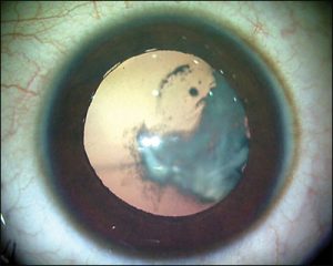 بیماری چشمی PHPV