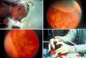 لیزر چشم نوزادان نارس