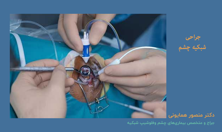 جراحی شبکیه چشم