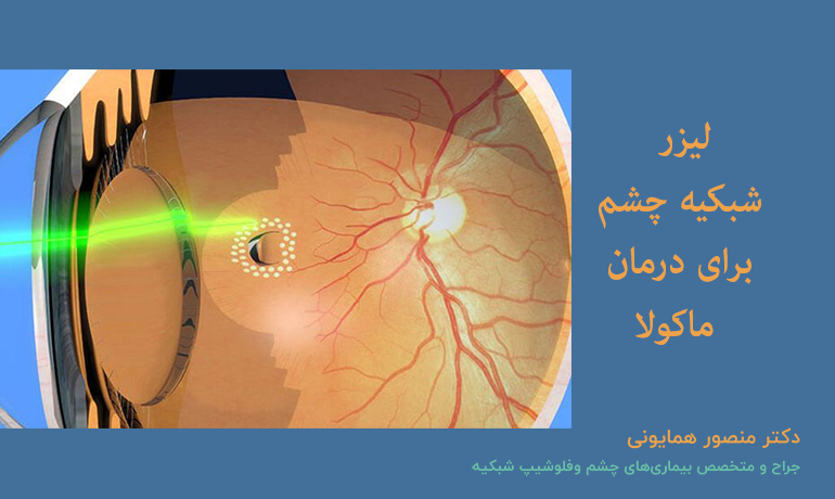 جراحی شبکیه چشم برای رفع ماکولا