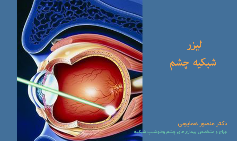 جراحی شبکیه چشم با لیزر