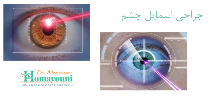 درباره جراحی اسمایل چشم