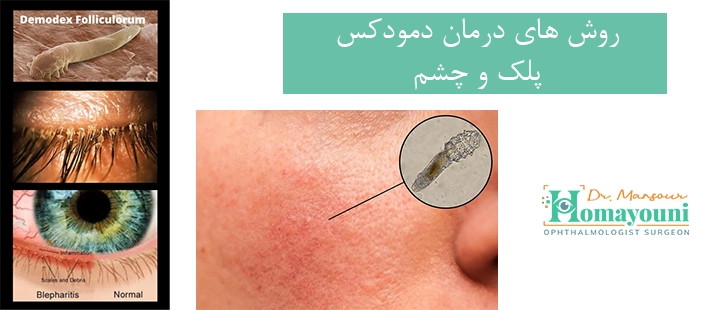 روش های درمان دمودکس پلک و چشم