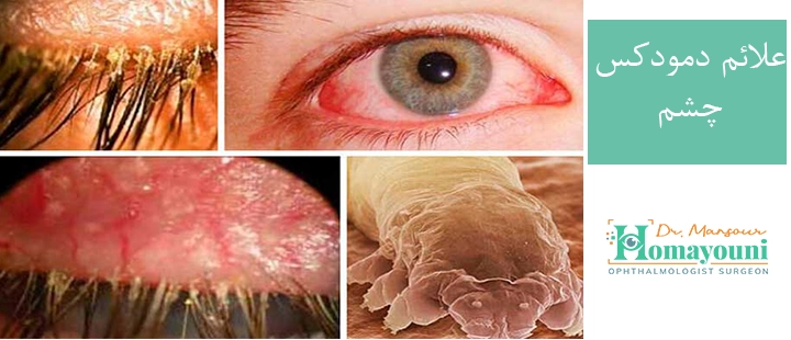 علائم دمودکس چشم