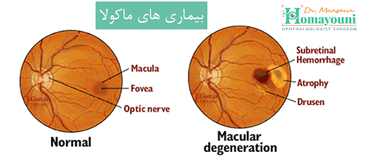 بیماری های ماکولا