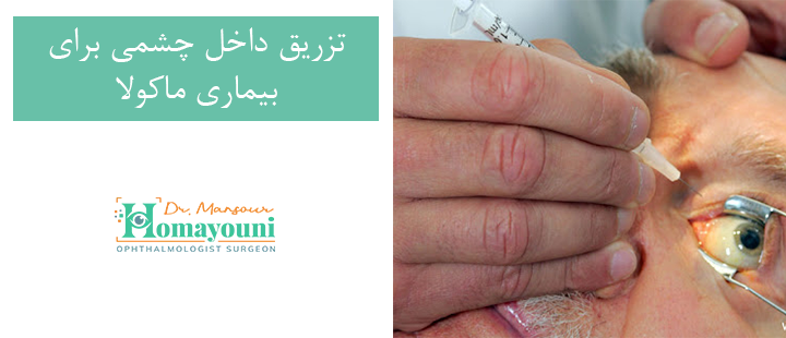 تزریق داخل چشمی برای بیماری ماکولا