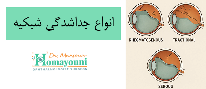 انواع جداشدگی شبکیه