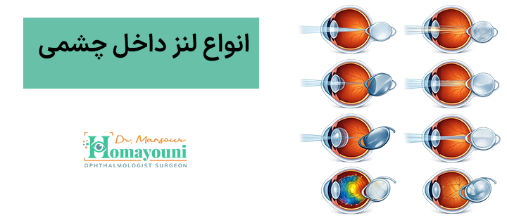 انواع لنز داخل چشمی