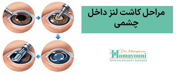 مراحل کاشت لنز داخل چشمی