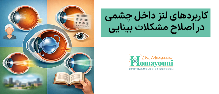 کاربردهای لنز داخل چشمی در اصلاح مشکلات بینایی