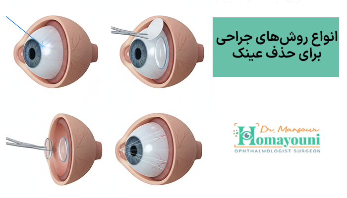 انواع روش‌های جراحی برای حذف عینک