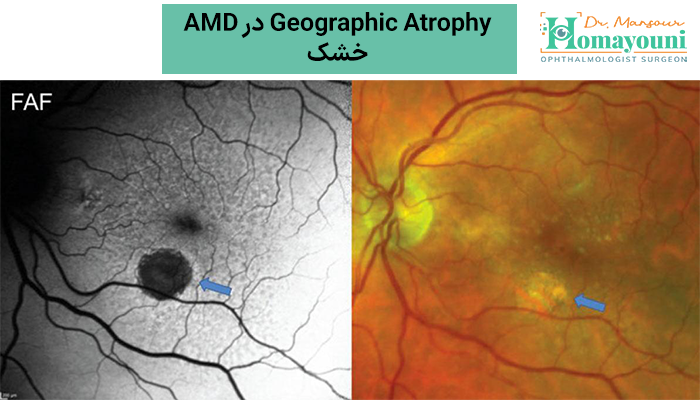 Geographic Atrophy در AMD خشک