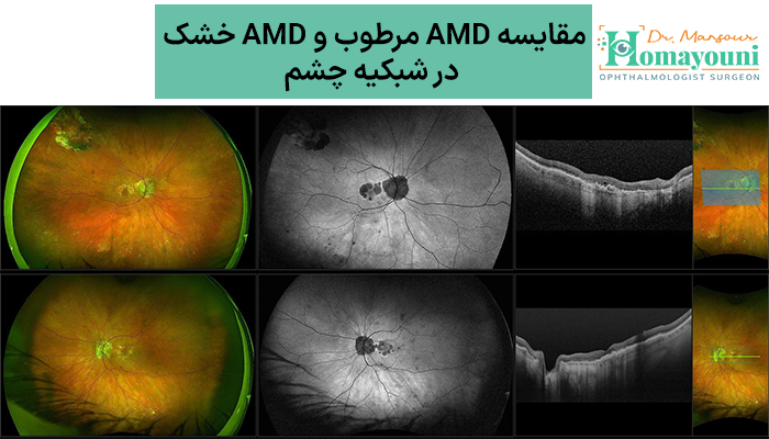 مقایسه AMD مرطوب و AMD خشک در شبکیه چشم